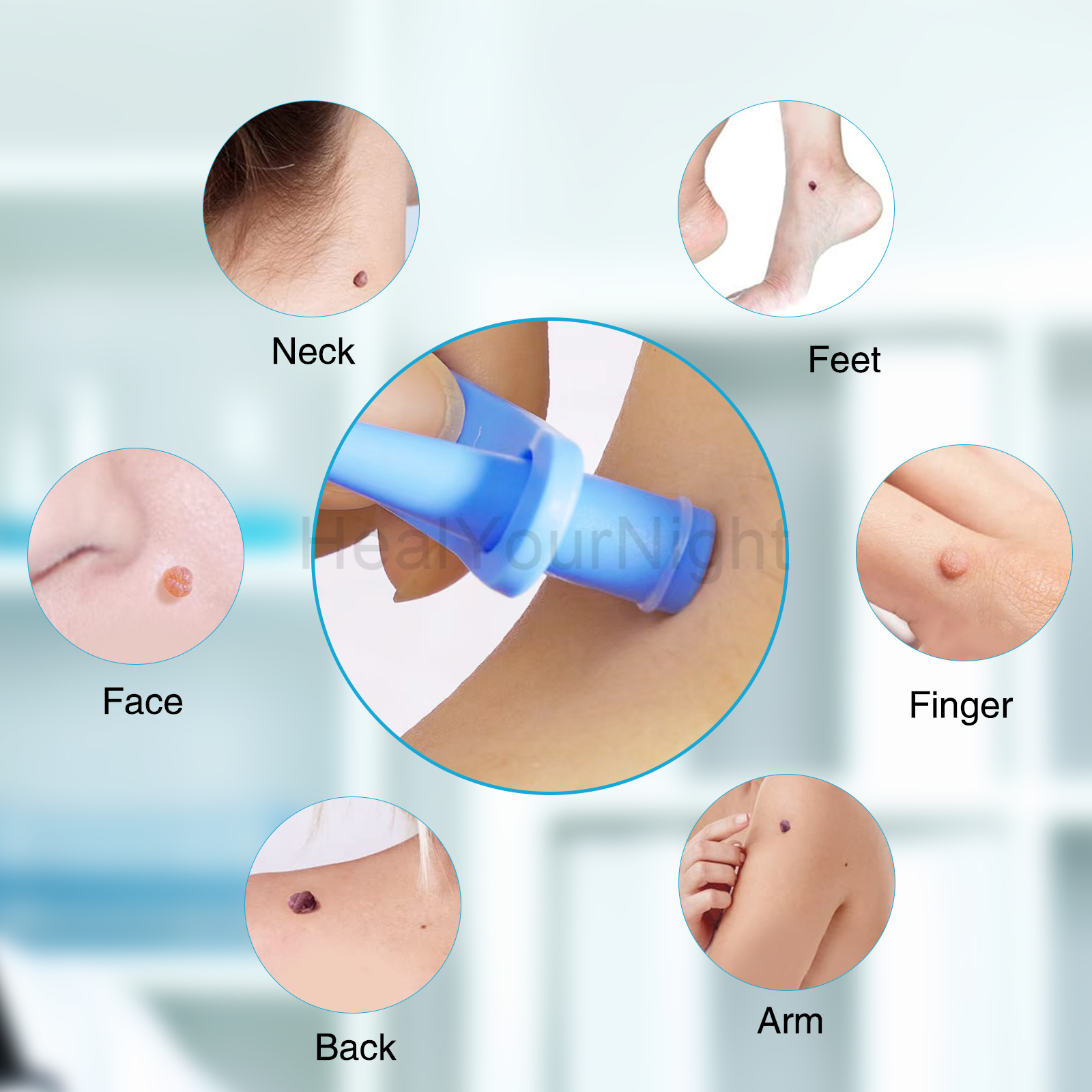 3-IN-1 Auto Skin Tag Removal K - đánh giá và giá Luxury Skincare Acne
