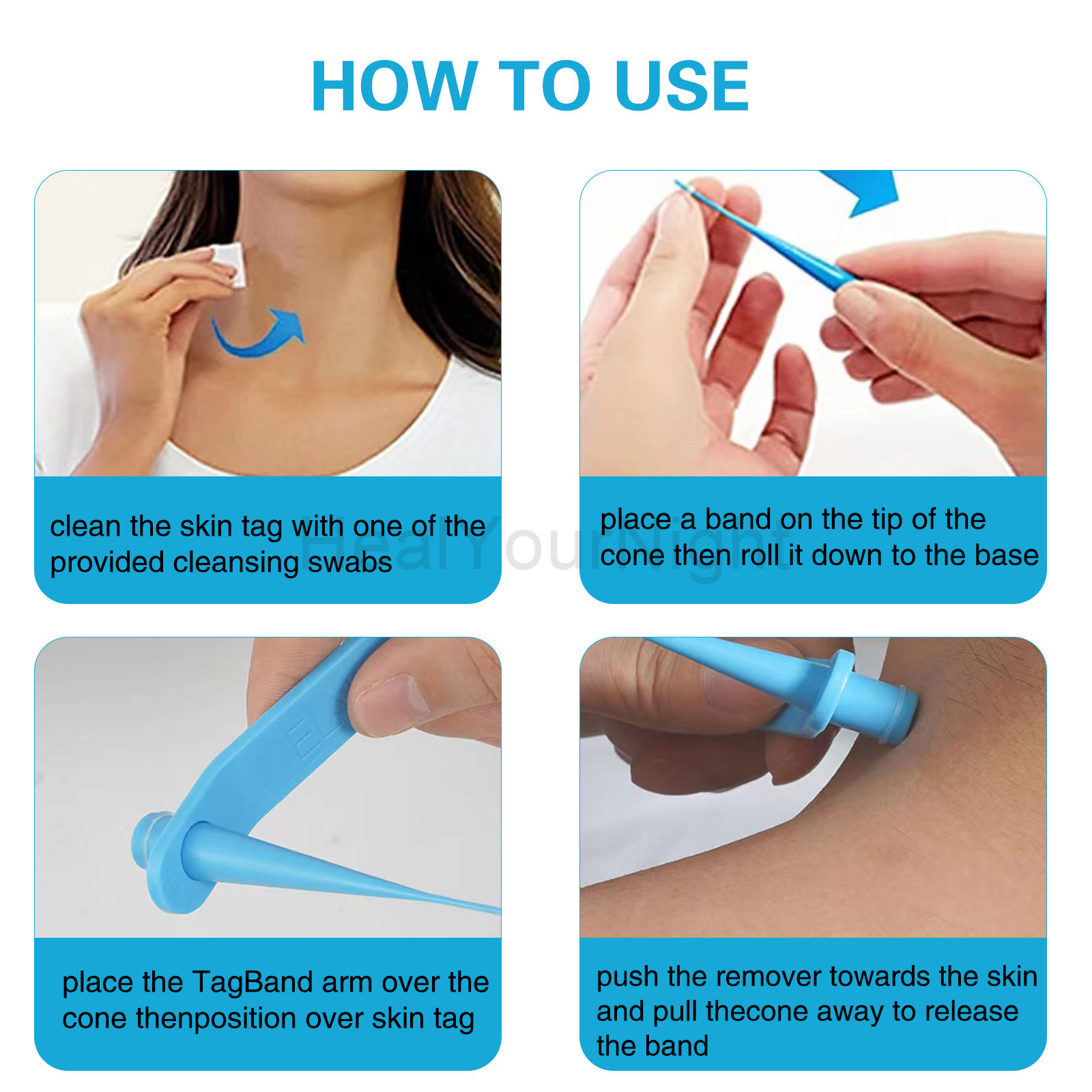 3-IN-1 Auto Skin Tag Removal K - đánh giá và giá Luxury Skincare Acne
