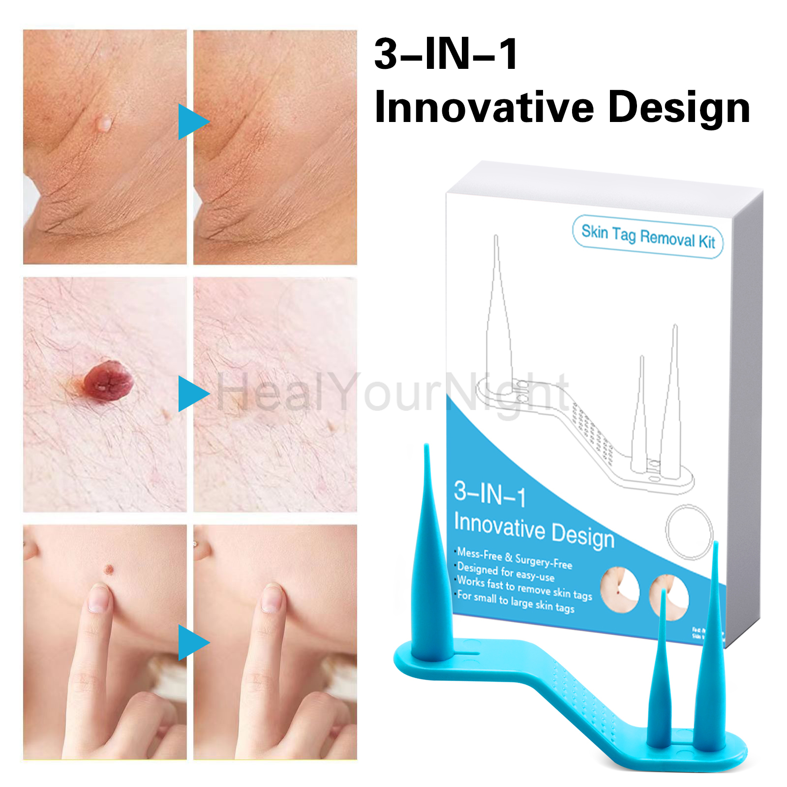 3-IN-1 Auto Skin Tag Removal K - đánh giá và giá Luxury Skincare Acne