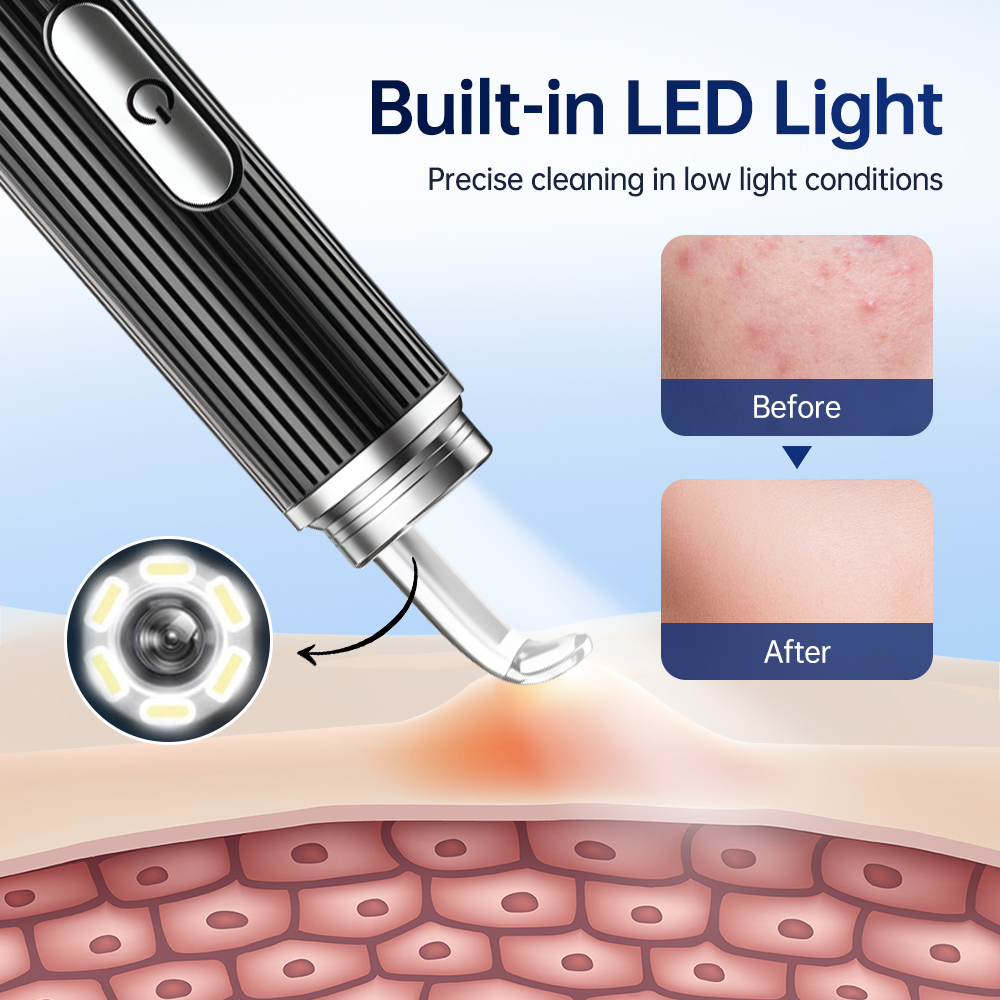 Visual Blackhead Remover with  - đánh giá và giá Luxury Skincare Acne