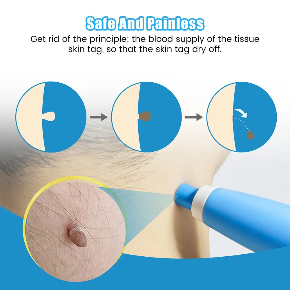 Auto Skin Tag Removal Tool Kit - đánh giá và giá Luxury Skincare Acne
