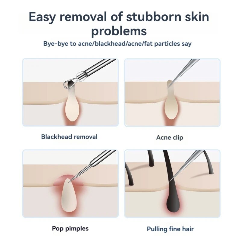 7pcs Stainless Steel Splinter  - đánh giá và giá Luxury Skincare Acne
