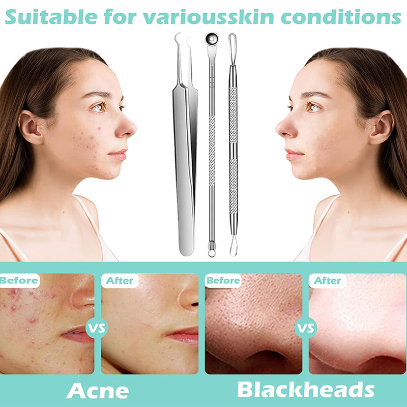 Acne Blackhead Removal Needles - đánh giá và giá Luxury Skincare Acne